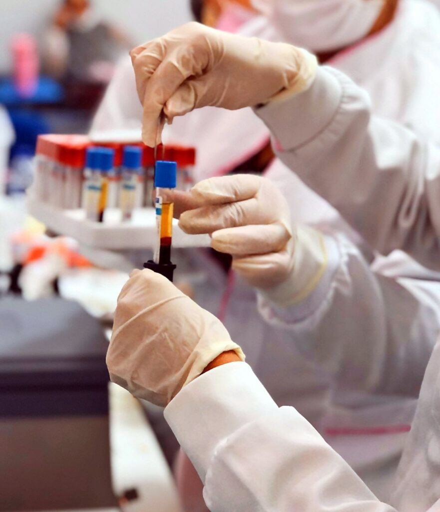 Tubo com plasma separado após centrifugação, no preparo de PRP da pós em Estética Avançada